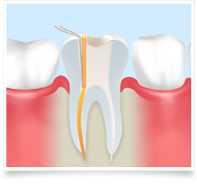 歯の根の病気とは？