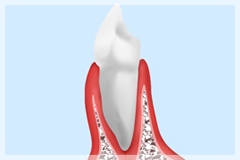 予防歯科のメリット